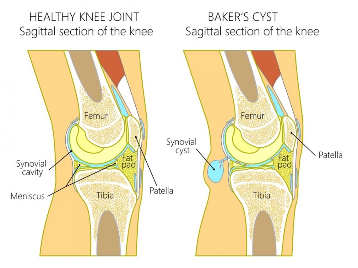 10 Common Causes of Knee Pain | Page 4 | Things Health