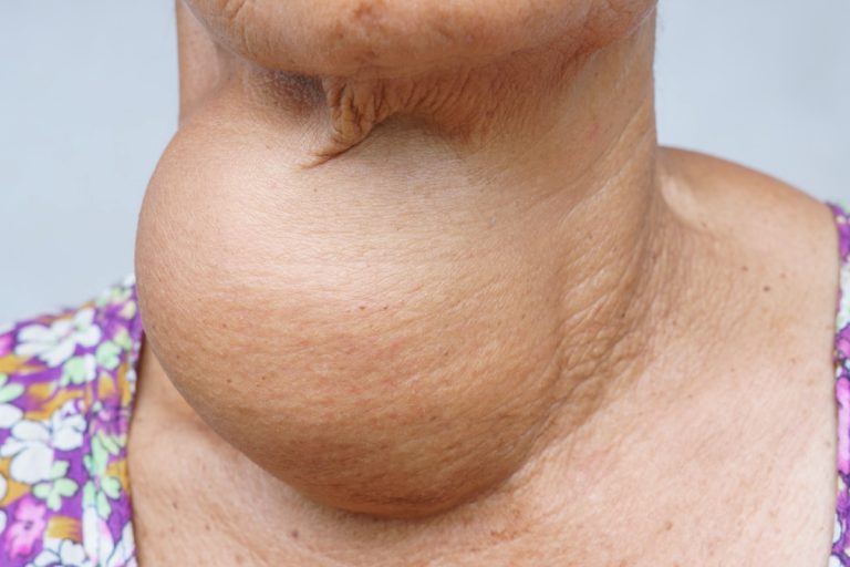 What Is The Difference Between A Toxic And Nontoxic Goiter