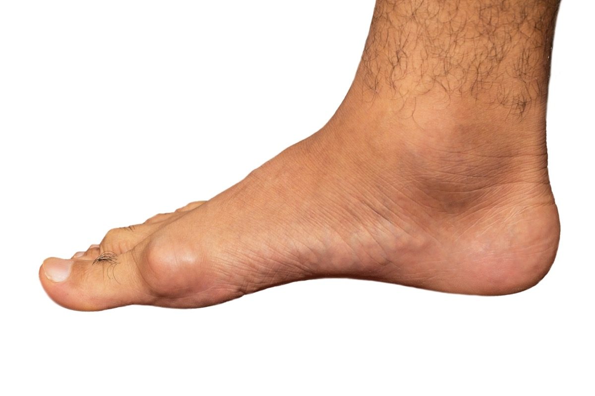 The Best Foods For Gout