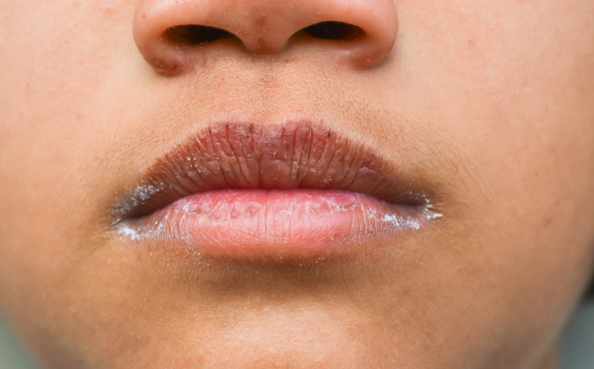 causes-of-dry-mouth-things-health