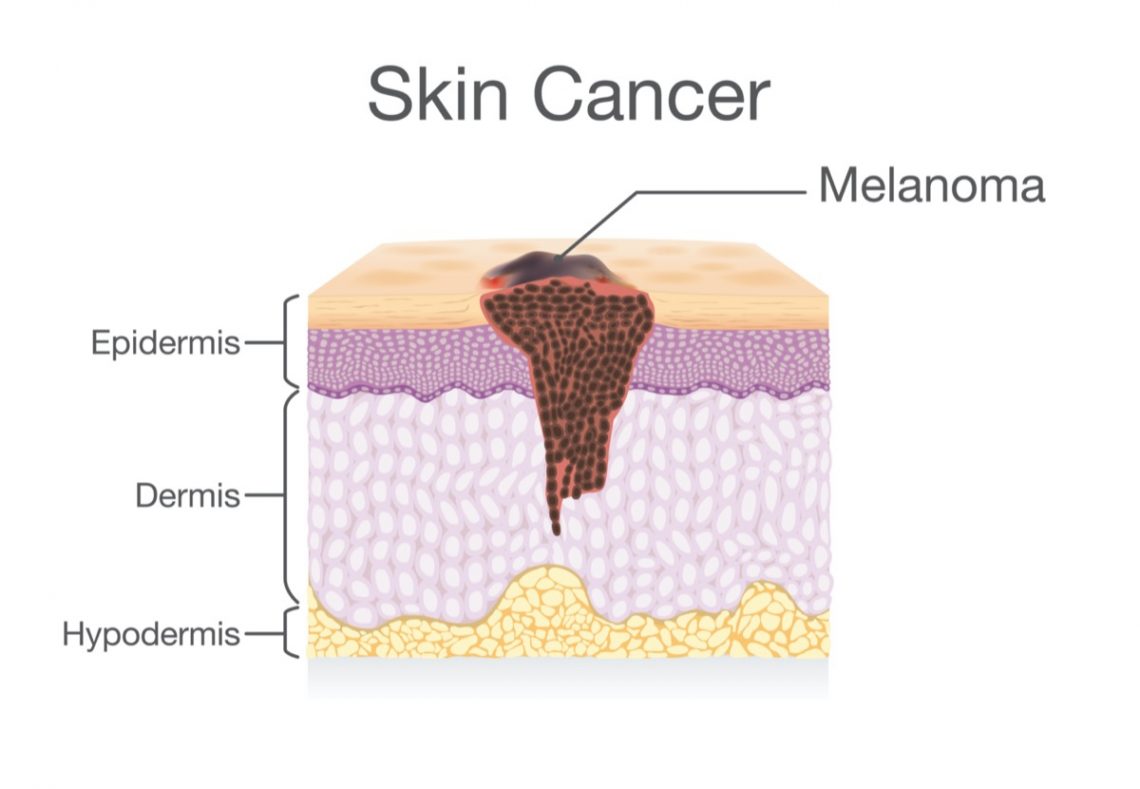 Subtle Signs of Skin Cancer You Should Never Ignore | Page 5 | Things ...