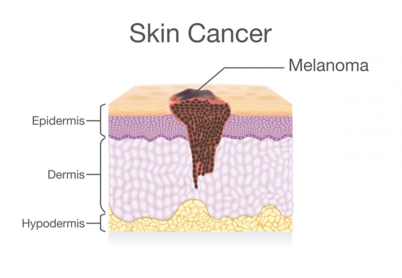 Subtle Signs Of Skin Cancer You Should Never Ignore Page 5 Things