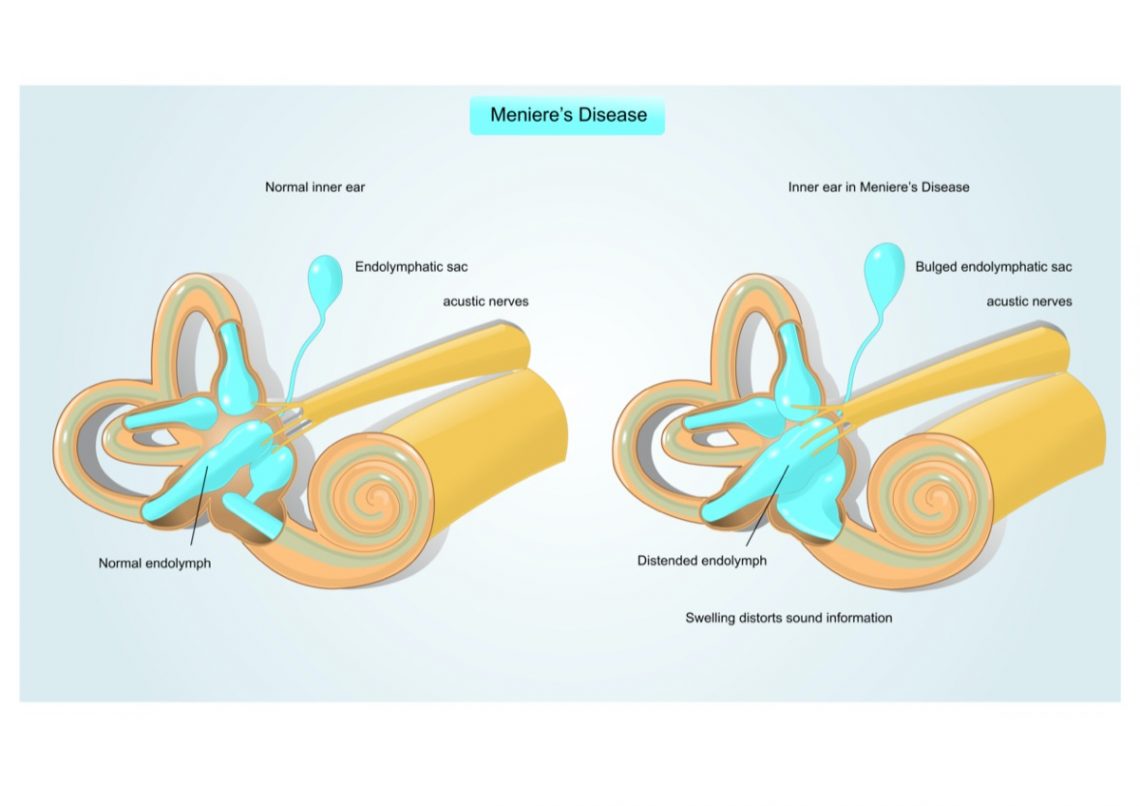 Signs and Symptoms of Meniere’s Disease Things Health