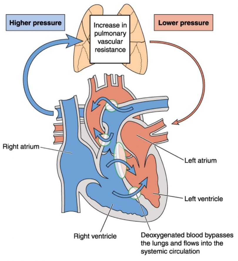 Pulmonary Arterial Hypertension | Page 4 | Things Health