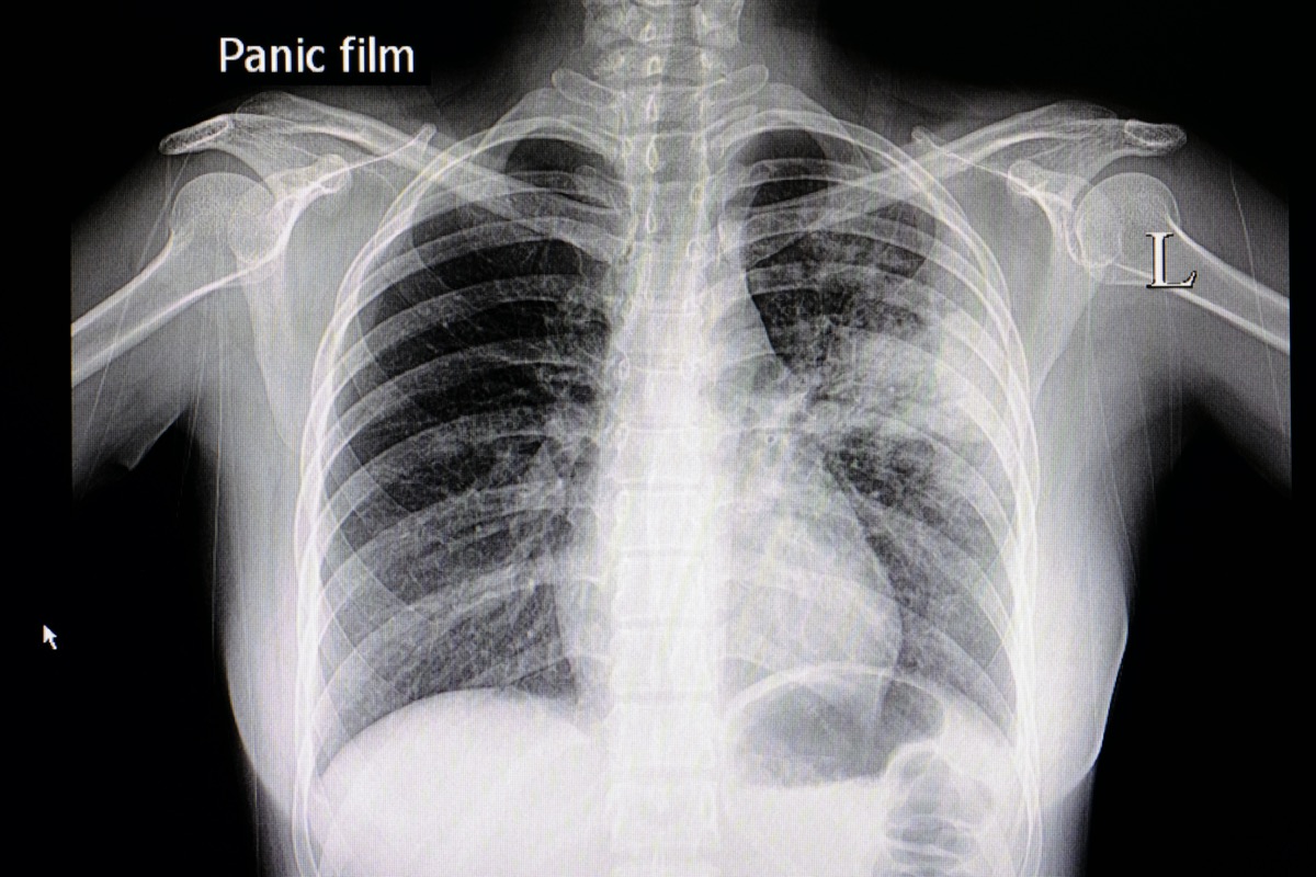 Сливная пневмония рентген